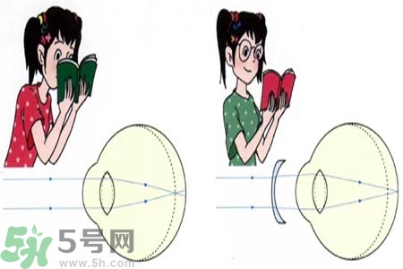 近視眼的發(fā)病因素？近視眼的并發(fā)癥有哪些？