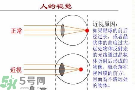 近視眼高發(fā)人群？如何預(yù)防近視眼？