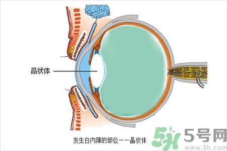 白內(nèi)障的護(hù)理措施是什么？白內(nèi)障的飲食護(hù)理有哪些？