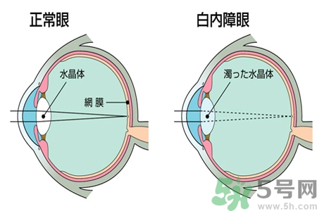 白內障治療方法是什么？白內障可以用什么藥物治療？