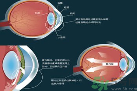 青光眼是什么？青光眼癥狀有什么？