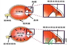 青光眼的發(fā)病因素是什么？青光眼的并發(fā)癥有哪些？
