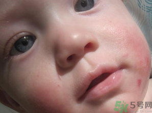 寶寶長奶蘚怎么回事？寶寶長奶蘚怎么辦？