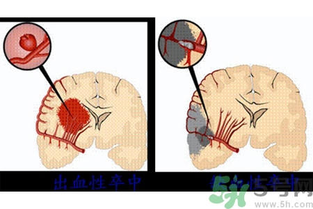 腦出血的發(fā)病因素是什么？腦出血的并發(fā)癥有哪些？