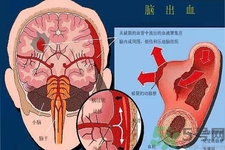 腦出血的發(fā)病因素是什么？腦出血的并發(fā)癥有哪些？