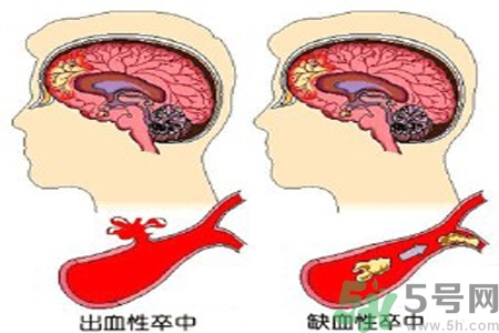 腦出血的治療方法是什么？腦出血可以用哪些藥物治療？