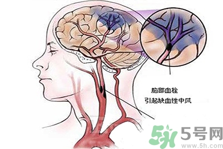 腦出血的治療方法是什么？腦出血可以用哪些藥物治療？