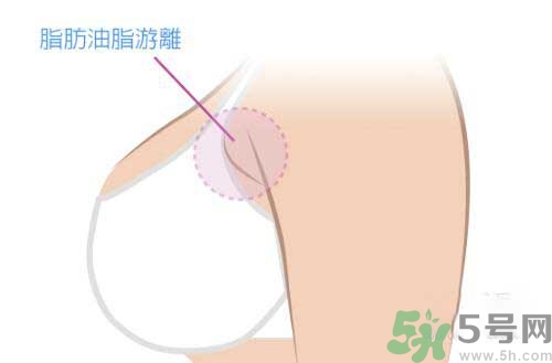 副乳是什么？副乳的危害