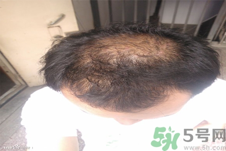 脫發(fā)的措施有什么？脫發(fā)的注意飲食有哪些？