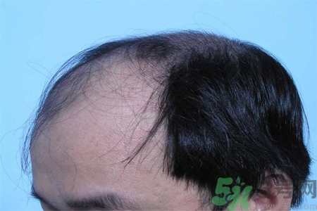 脫發(fā)的措施有什么？脫發(fā)的注意飲食有哪些？
