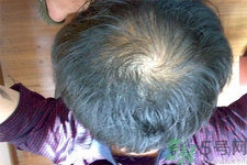 脫發(fā)的高發(fā)人群有哪些？如何預(yù)防脫發(fā)？