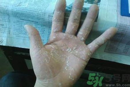 引起手足癬的主要原因？手足癬會(huì)引發(fā)什么疾??？
