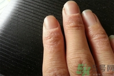 手足癬的治療方法？治療手足癬可以用什么藥？
