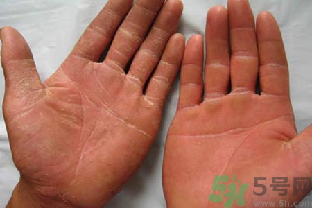 手足癬的治療方法？治療手足癬可以用什么藥？