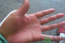 手足癬的易發(fā)人群有哪些？如何預(yù)防手足癬？