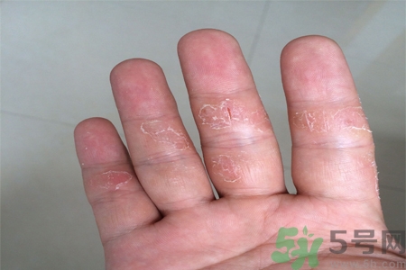 手足癬的易發(fā)人群有哪些？如何預(yù)防手足癬？