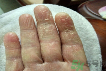 手足癬會傳染嗎？手足癬的傳播途徑有哪些？