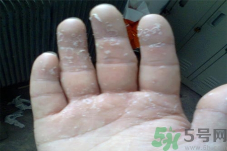 手足癬會傳染嗎？手足癬的傳播途徑有哪些？