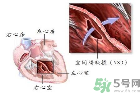 心臟病是怎么形成的？易發(fā)人群有哪些？