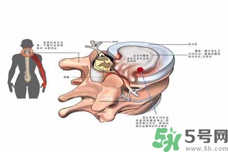 為什么年輕人容易得頸椎病？頸椎病嚴(yán)重的癥狀有哪些？