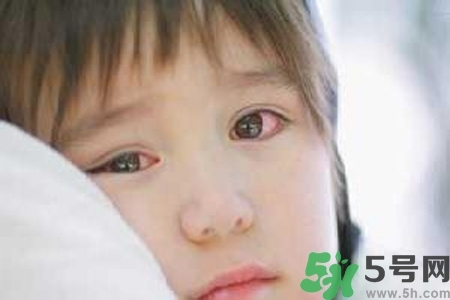 寶寶為什么會(huì)感染紅眼??？寶寶患紅眼病如何治療？