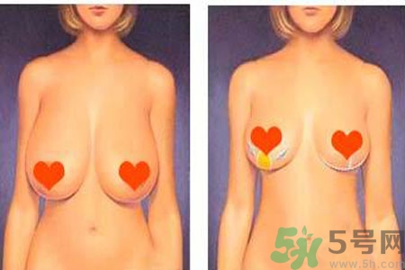 ?女性乳房下垂的原因是什么？女性乳房下垂的分類有哪些？