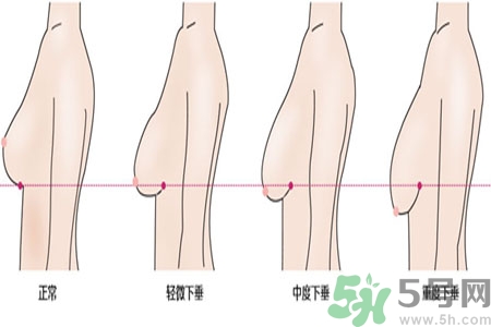 ?女性乳房下垂的原因是什么？女性乳房下垂的分類有哪些？
