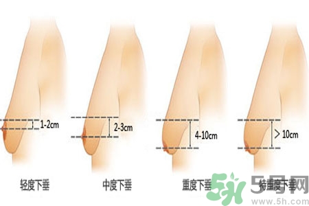 ?女性乳房下垂的原因是什么？女性乳房下垂的分類有哪些？
