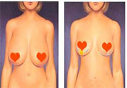 ?女性乳房下垂的原因是什么？女性乳房下垂的分類有哪些？