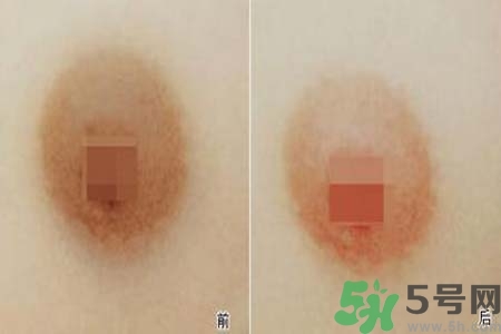 乳頭發(fā)黑怎么辦？怎么樣可以使乳頭變白？