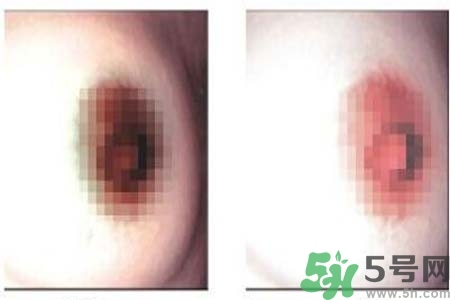 乳頭發(fā)黑怎么辦？怎么樣可以使乳頭變白？