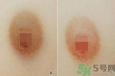 乳頭發(fā)黑是怎么回事？乳頭發(fā)黑是什么原因？