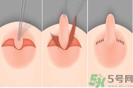 乳頭內(nèi)陷怎么回事？乳頭內(nèi)陷的原因是什么？