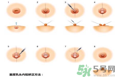 乳頭內(nèi)陷怎么回事？乳頭內(nèi)陷的原因是什么？