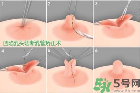 乳頭內(nèi)陷怎么辦？乳頭內(nèi)陷的癥狀有哪些？