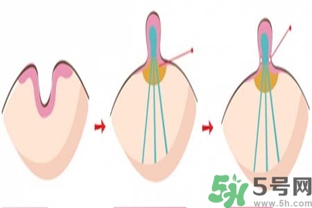 乳頭內(nèi)陷怎么辦？乳頭內(nèi)陷的癥狀有哪些？