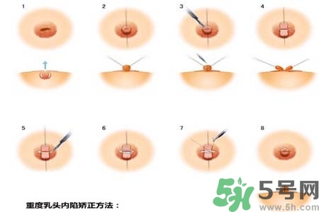 乳頭內(nèi)陷怎么辦？乳頭內(nèi)陷的癥狀有哪些？