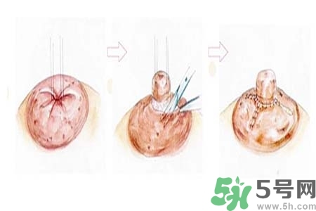 乳頭內(nèi)陷怎么辦？乳頭內(nèi)陷的癥狀有哪些？
