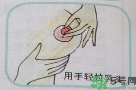 乳頭內(nèi)陷怎么辦？乳頭內(nèi)陷的癥狀有哪些？