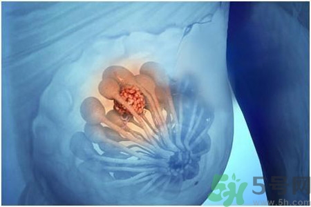 乳房有硬塊正常嗎？乳房有腫塊怎么回事？