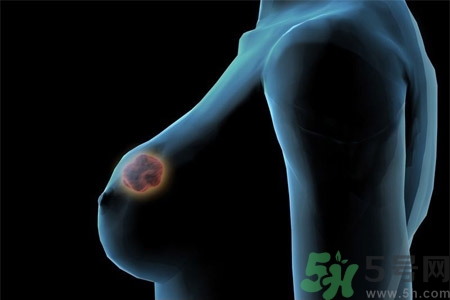 乳房有硬塊正常嗎？乳房有腫塊怎么回事？