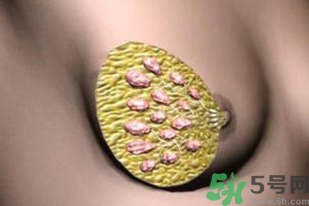 乳腺增生鈣化是什么？乳腺鈣化的癥狀有哪些？