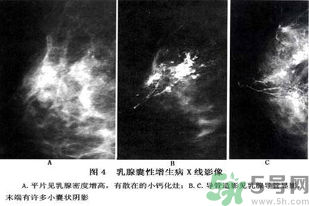 乳腺增生鈣化是什么？乳腺鈣化的癥狀有哪些？