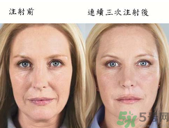 3D液態(tài)拉皮多少錢？3D液態(tài)拉皮后多久見效？