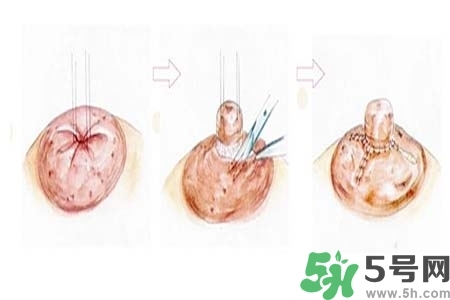 乳頭內(nèi)陷怎么矯正？乳頭內(nèi)陷矯正方法是什么？