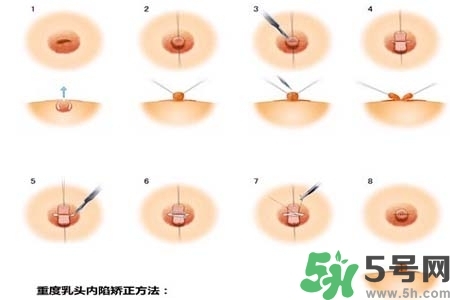 乳頭內(nèi)陷怎么矯正？乳頭內(nèi)陷矯正方法是什么？