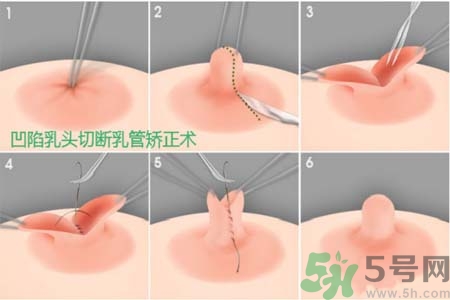 乳頭內(nèi)陷怎么矯正？乳頭內(nèi)陷矯正方法是什么？