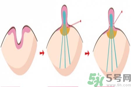 乳頭內(nèi)陷矯正需注意什么？乳頭內(nèi)陷如何預(yù)防？