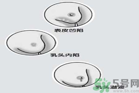 乳頭內(nèi)陷矯正需注意什么？乳頭內(nèi)陷如何預(yù)防？