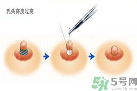 乳頭內(nèi)陷能不能喂奶？乳頭凹陷怎樣哺乳？
